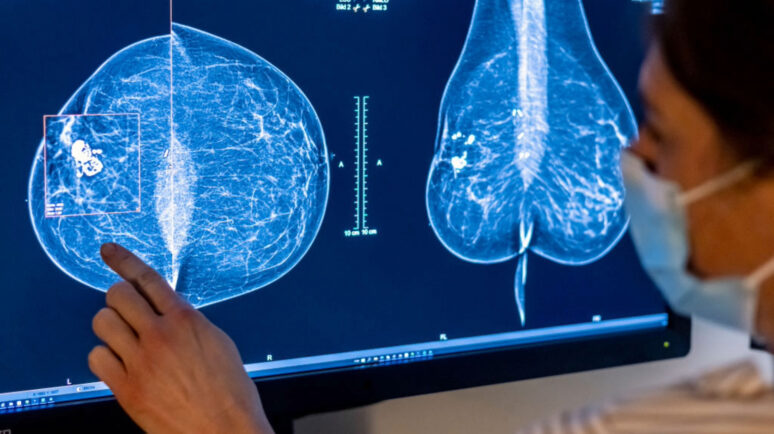 Mammogram, mia AI